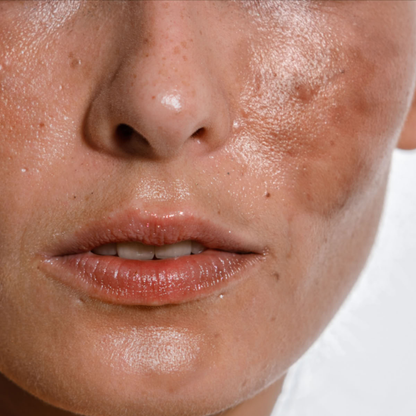 Kojic Boost Dark Spot care